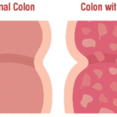 Cartoon of a normal colon and a colon with ulcerative colitis. The colon with ulcerative colitis is darker in red indicating inflammation and has many ulcers present.
