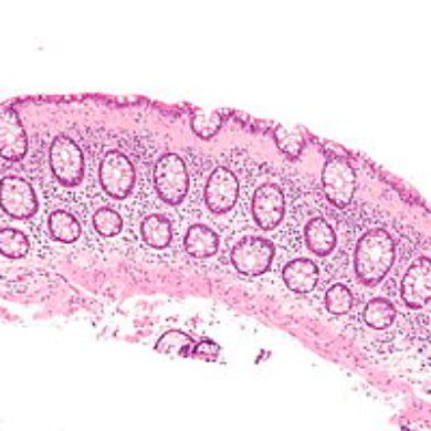 A cell biopsy which is a tissue sample from the bowel showing collagenous colitis.