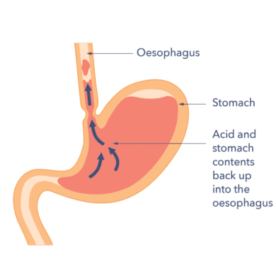 A stomach with arrows pointing to the oesophagus and stomach. There are arrows going from the stomach to oesophagus to indicate acid and stomach contents going back up into the oesophagus.