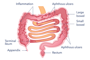 A diagram of the small and large intestine. Labelled are inflammation, aphthous ulcers, large bowel, small bowel, aphthous ulcers, rectum, appendix and terminal ileum