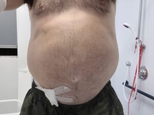 Cornelius's upper half of his body is seen. He has a build up of fluid in his abdomen, which is called ascites. There is tape on the bottom part of his belly.