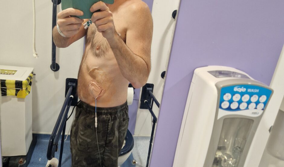 Cornelius is taking a mirror selfie in a toilet at a medical facility. He is topless with a pair of gray sweat bottoms. He has some tubes attached to the side of his belly.