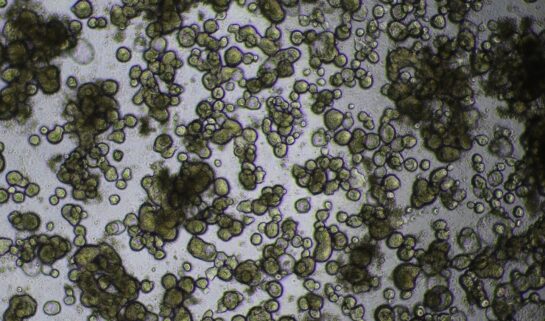 Miniguts organoids from the inflamed part of a patient's bowel.