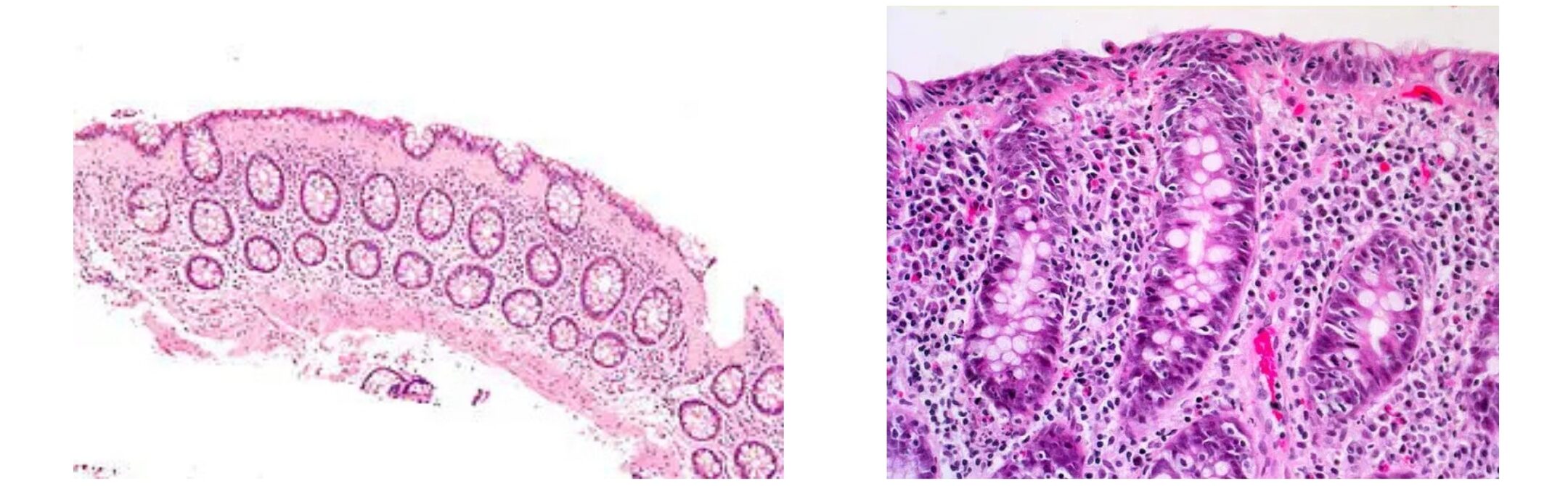 Micrograph images of collagenous colitis and lymphocytic colitis