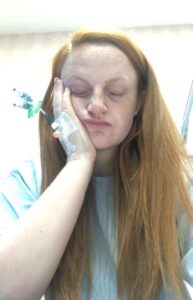 Rachel has her eyes closed and she rests her head on her hand. She is wearing a hospital gown. An IV is taped to her hand.