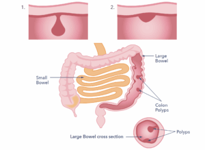 A diagram showing the small and large bowel and a polyp.