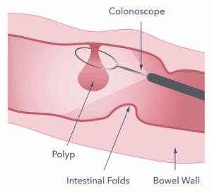 A diagram of a polyp being removed from the bowel.