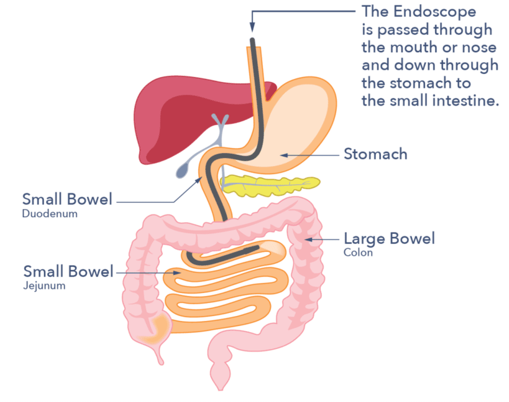 A diagram of the digestive system with the stomach, small bowel and large bowel labelled. An endoscope is shown being passed through the mouth or nose and down through the stomach to the small intestine.