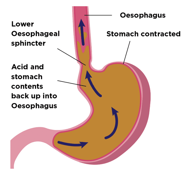 Guts UK's diagram of the stomach, showing acid and stomach contents heading back up into the lower oesophageal sphincter