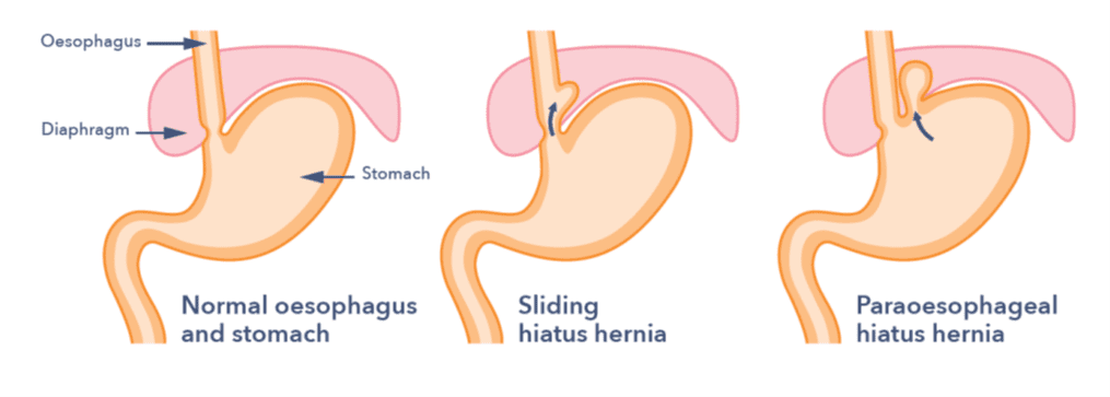 Guts UK's diagram of a normal oesophagus and stomach, a stomach with a sliding hiatus hernia and a paraoesophageal hiatus hernia.
