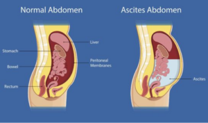 A diagram of a normal abdomen vs. an abdomen of someone with ascites.