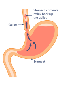 A diagram of the stomach and gullet showing how stomach contents moves upwards.