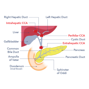 A diagram showing the different locations of cancer within the bile duct.