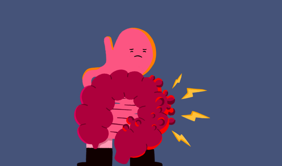An illustration of Diverticular Dave, a Guts UK brand character shaped like a gut, showing signs of diverticular disease.