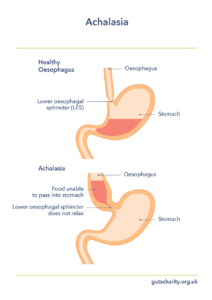 An illustration showing how a healthy oesophagus can digest food in comparison to an oesophagus affected by achalasia.